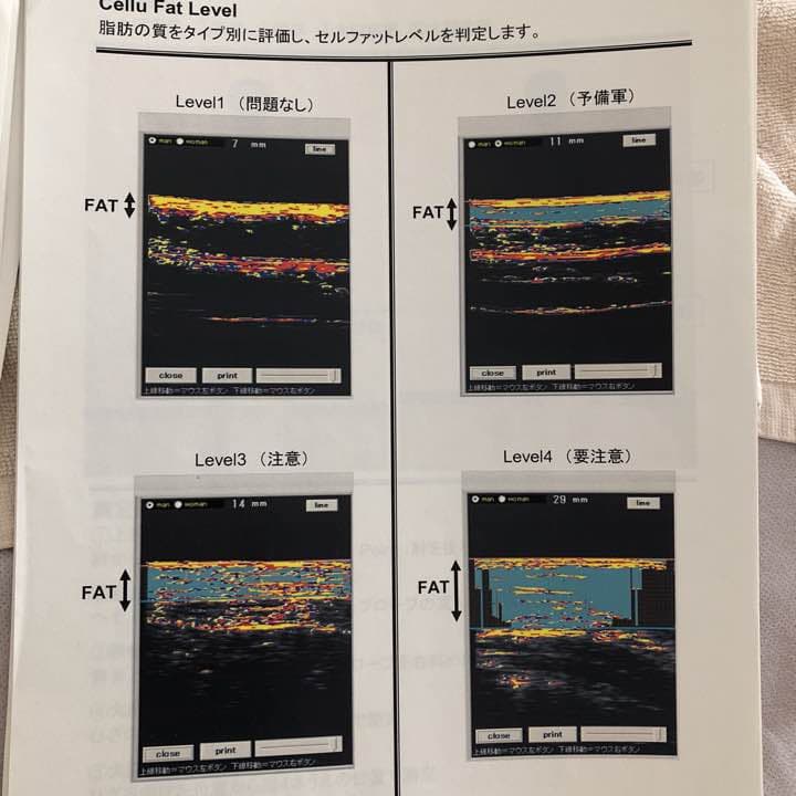 超音波画像診断器 パソコン付き　脂肪、筋肉　接骨院　エステ